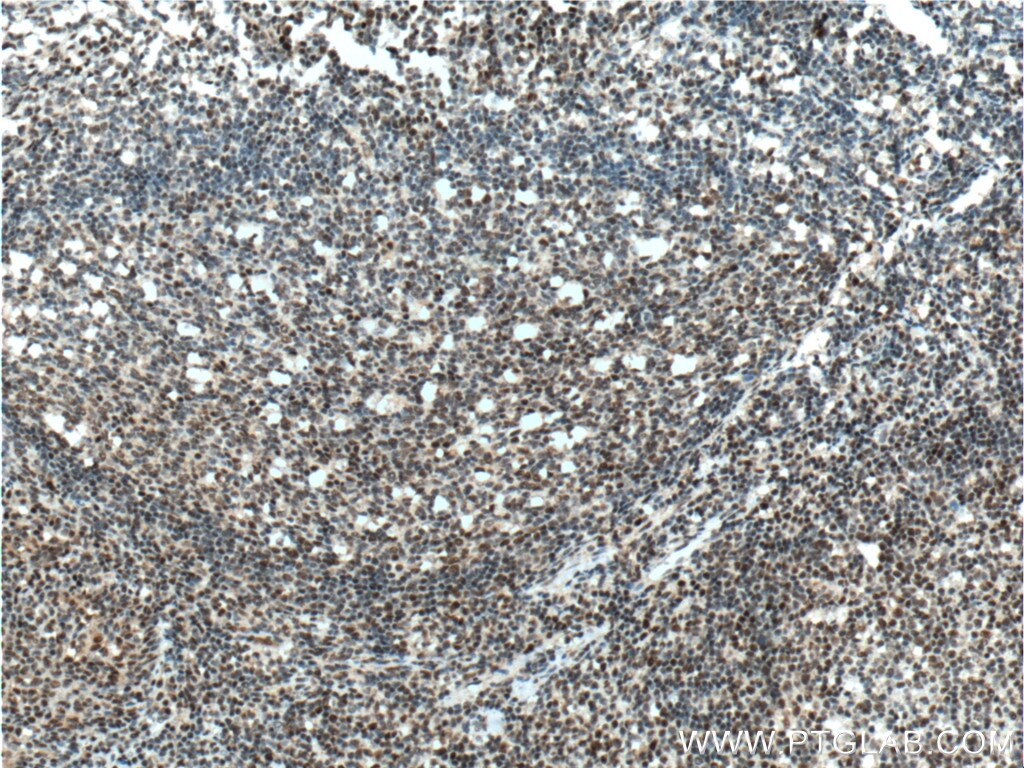 Immunohistochemistry (IHC) staining of human tonsillitis tissue using CUL4B Polyclonal antibody (20882-1-AP)