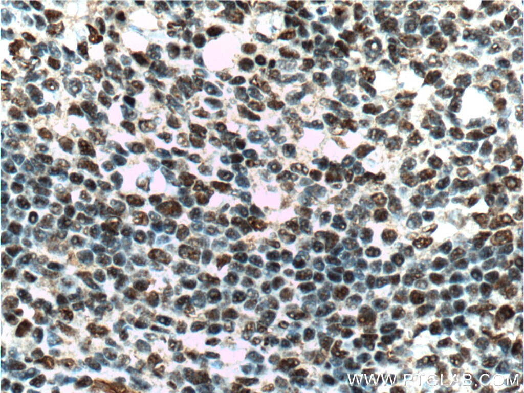 Immunohistochemistry (IHC) staining of human tonsillitis tissue using CUL4B Polyclonal antibody (20882-1-AP)