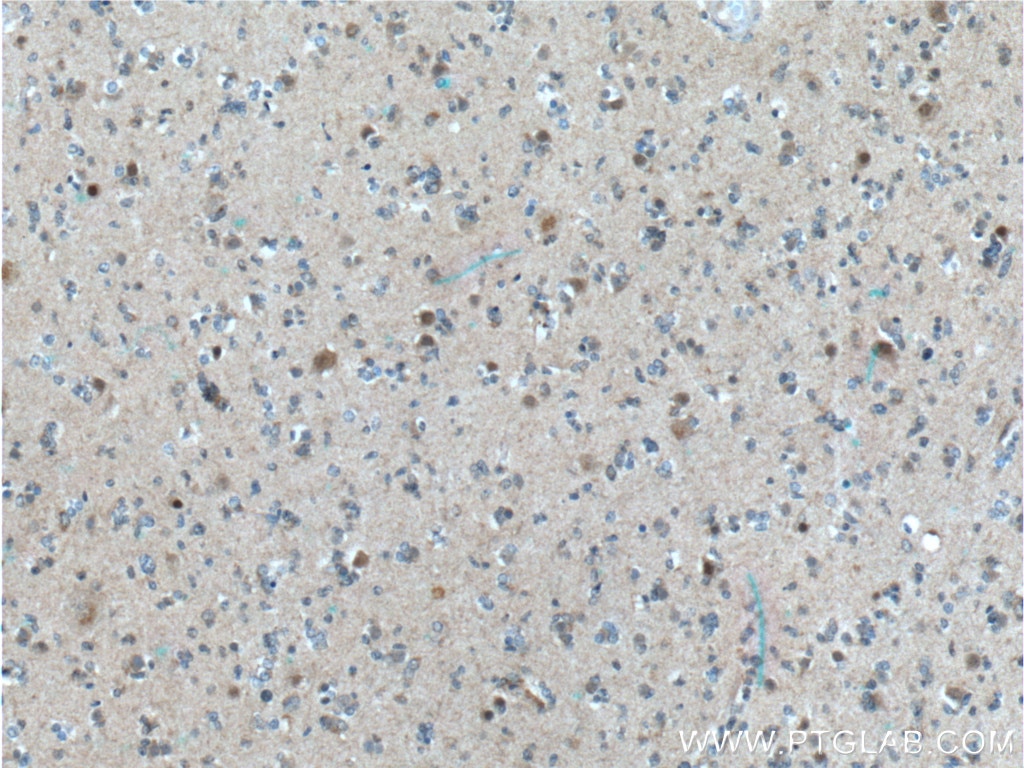 Immunohistochemistry (IHC) staining of human gliomas tissue using CUL4B Monoclonal antibody (60151-1-Ig)