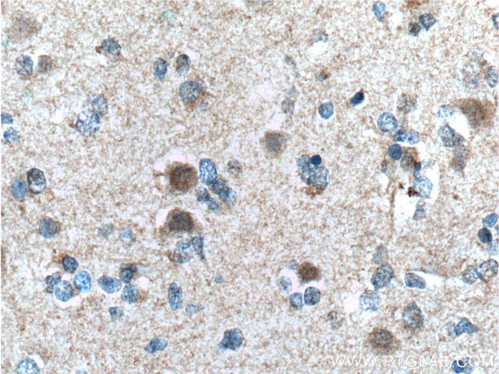 Immunohistochemistry (IHC) staining of human gliomas tissue using CUL4B Monoclonal antibody (60151-1-Ig)