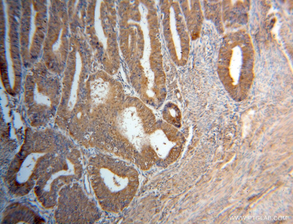 Immunohistochemistry (IHC) staining of human endometrial cancer tissue using CUTC Polyclonal antibody (15030-1-AP)