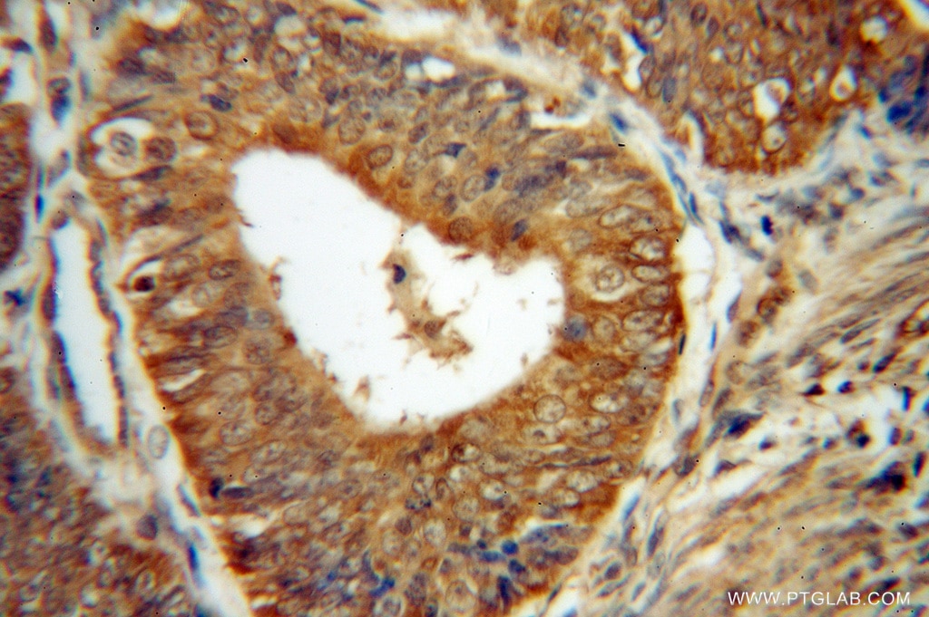 IHC staining of human endometrial cancer using 15030-1-AP