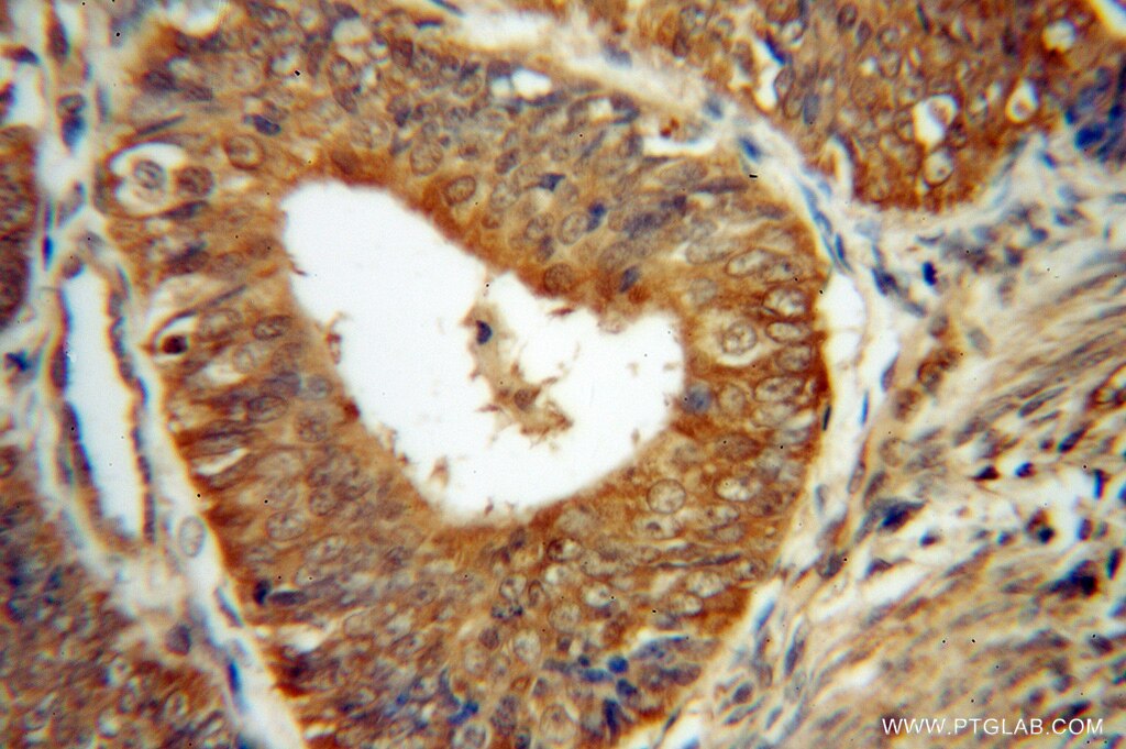 Immunohistochemistry (IHC) staining of human endometrial cancer tissue using CUTC Polyclonal antibody (15030-1-AP)