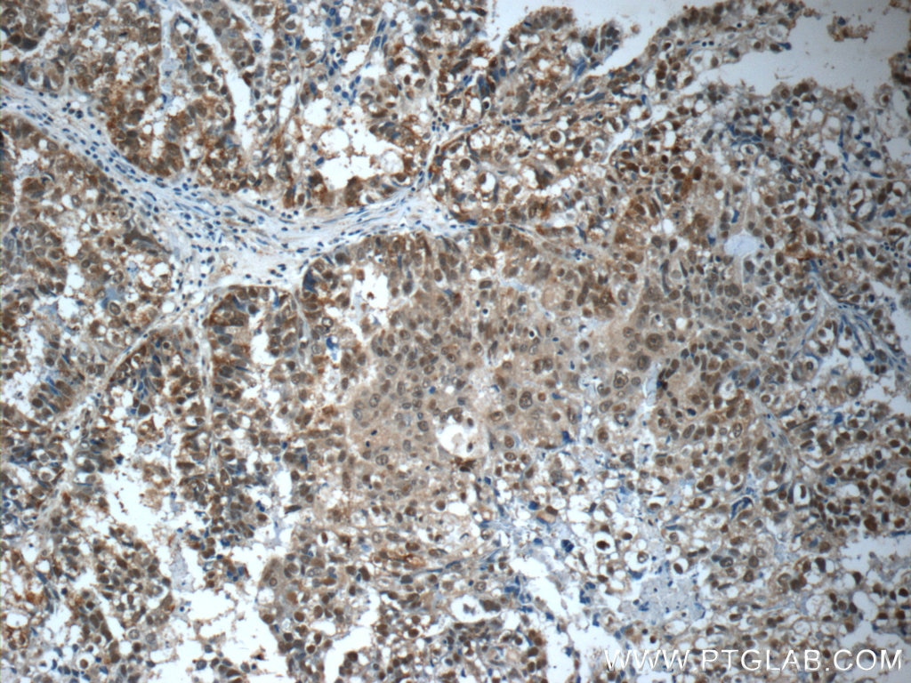 Immunohistochemistry (IHC) staining of human breast cancer tissue using CWC15 Polyclonal antibody (25293-1-AP)