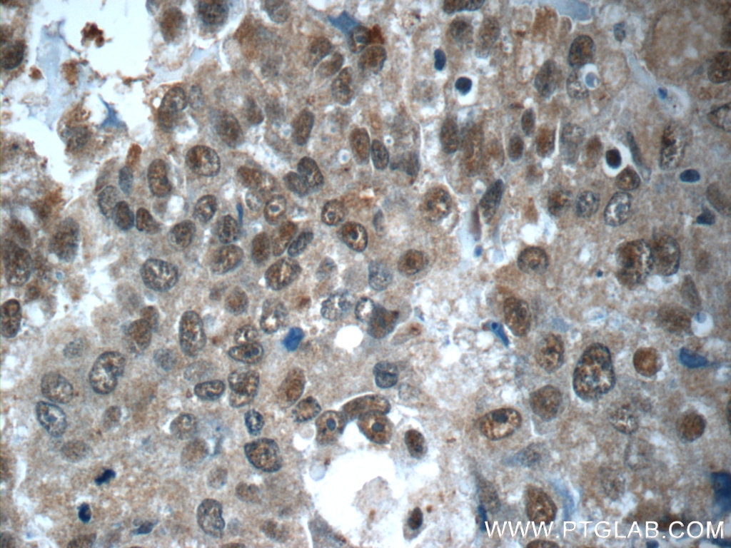 Immunohistochemistry (IHC) staining of human breast cancer tissue using CWC15 Polyclonal antibody (25293-1-AP)