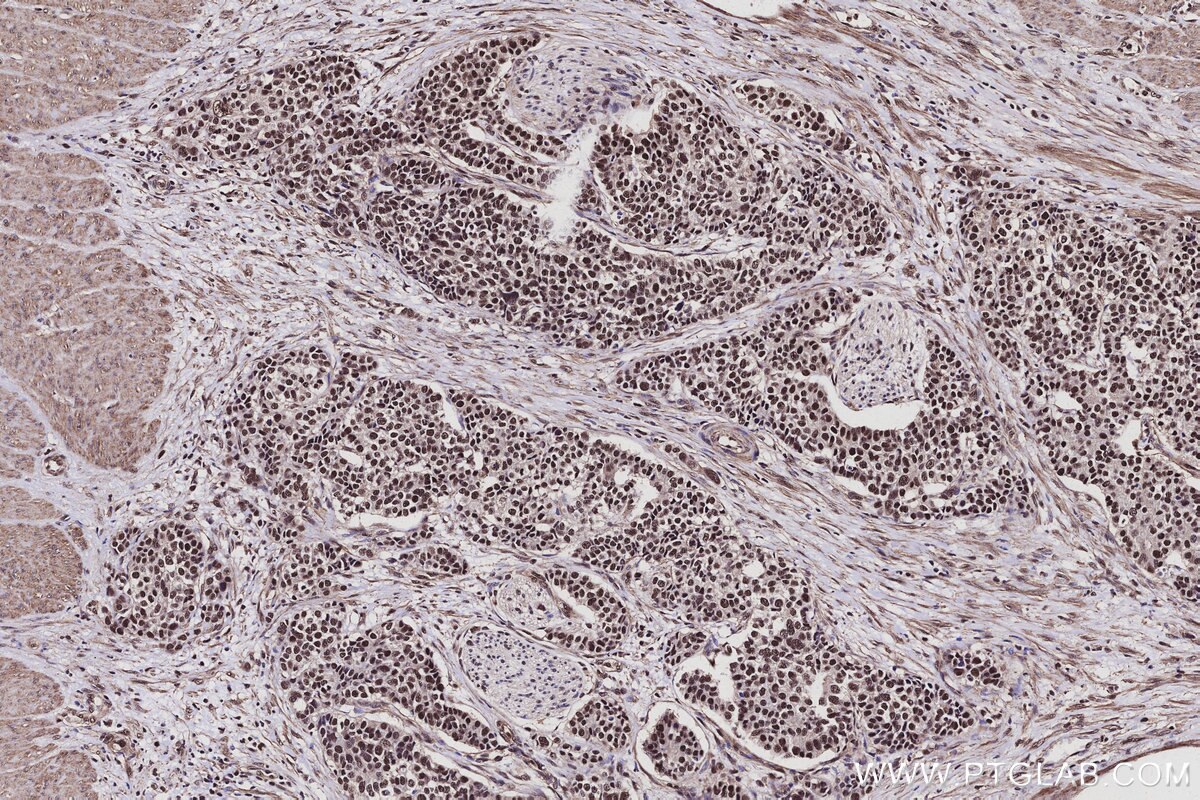 Immunohistochemistry (IHC) staining of human stomach cancer tissue using CWF19L1 Polyclonal antibody (31700-1-AP)