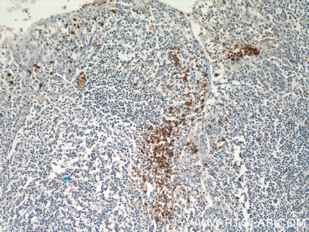 Immunohistochemistry (IHC) staining of human tonsillitis tissue using CX3CR1 Polyclonal antibody (13885-1-AP)
