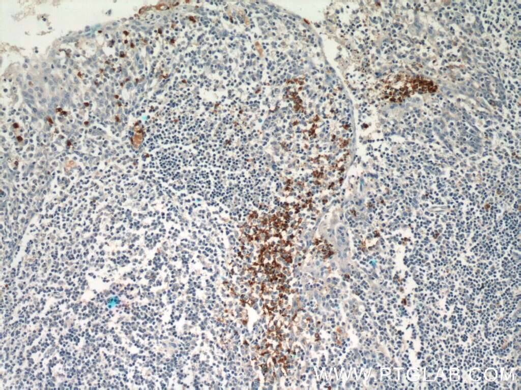 Immunohistochemistry (IHC) staining of human tonsillitis tissue using CX3CR1 Polyclonal antibody (13885-1-AP)