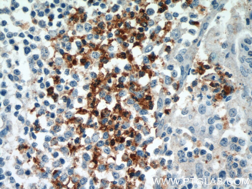 Immunohistochemistry (IHC) staining of human tonsillitis tissue using CX3CR1 Polyclonal antibody (13885-1-AP)