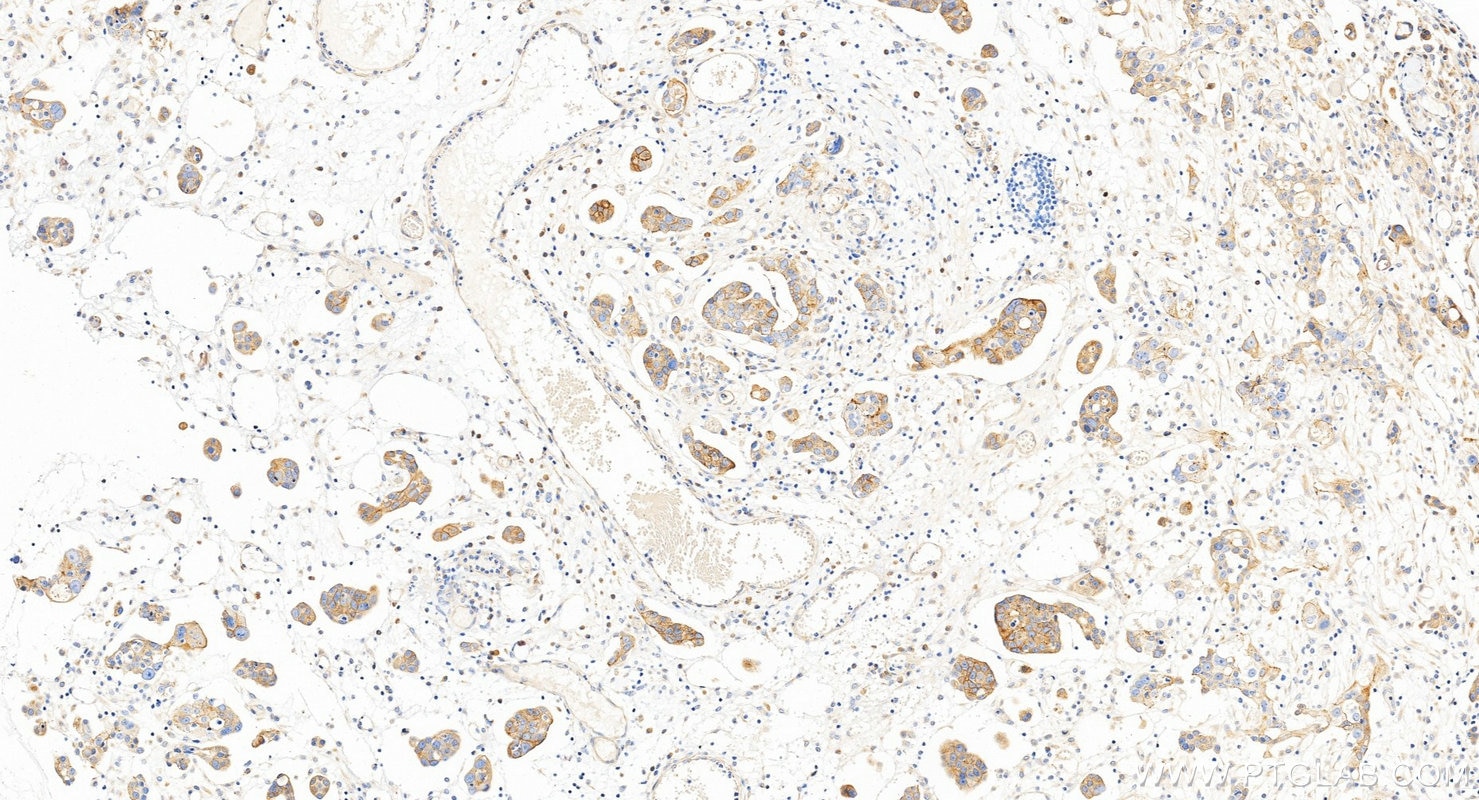 Immunohistochemistry (IHC) staining of human ovary cancer tissue using CXADR Polyclonal antibody (11777-1-AP)