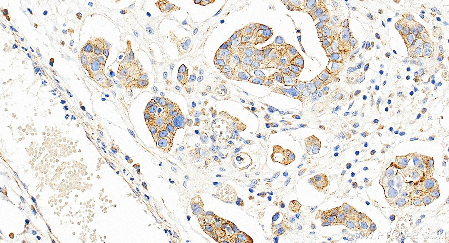 Immunohistochemistry (IHC) staining of human ovary cancer tissue using CXADR Polyclonal antibody (11777-1-AP)