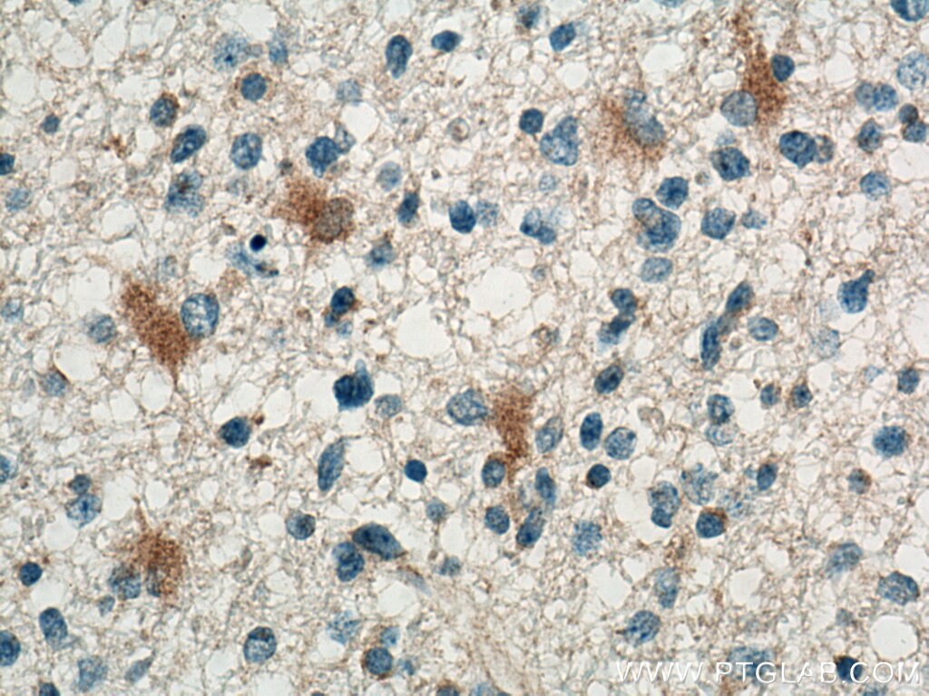 IHC staining of human gliomas using 12335-1-AP