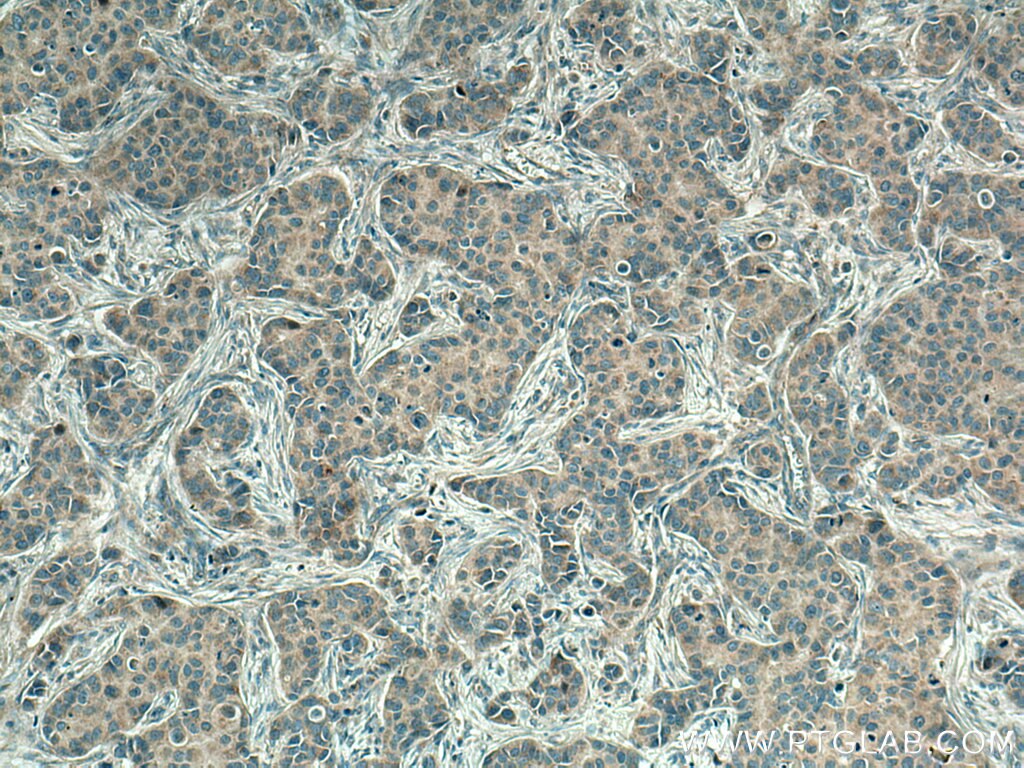 IHC staining of human breast cancer using 12335-1-AP