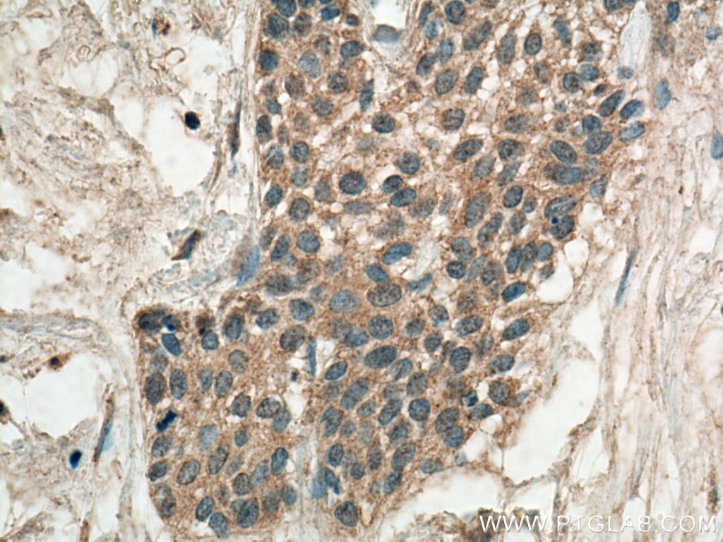 IHC staining of human urothelial carcinoma using 12335-1-AP