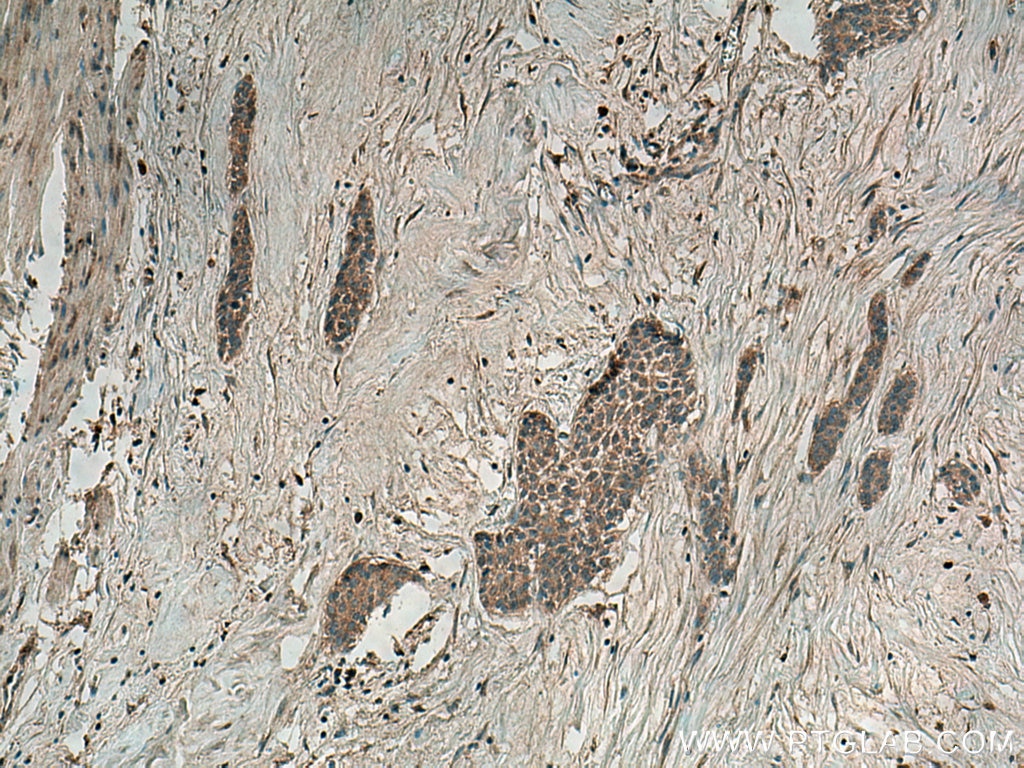IHC staining of human urothelial carcinoma using 12335-1-AP