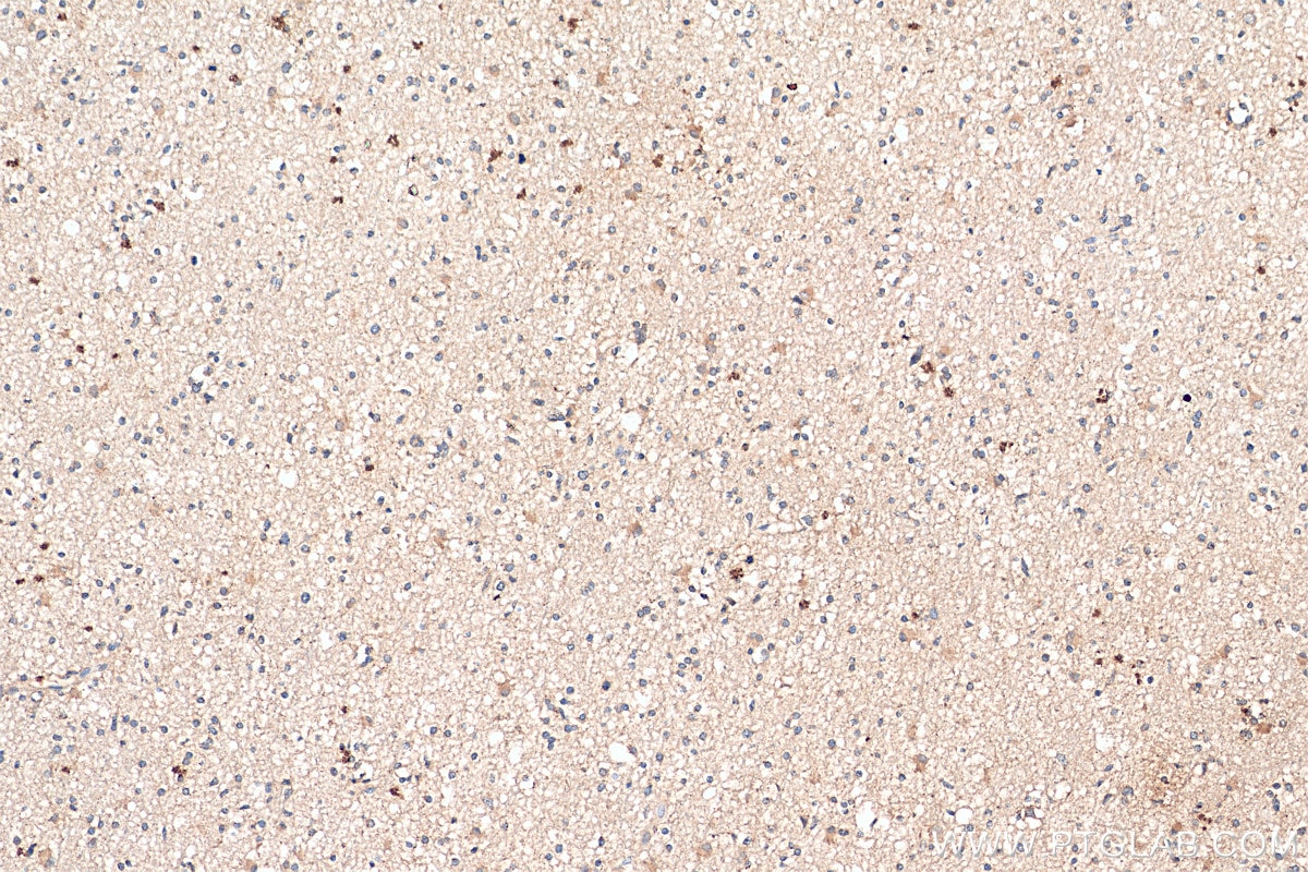 Immunohistochemistry (IHC) staining of human gliomas tissue using CXCL1 Polyclonal antibody (12335-1-AP)