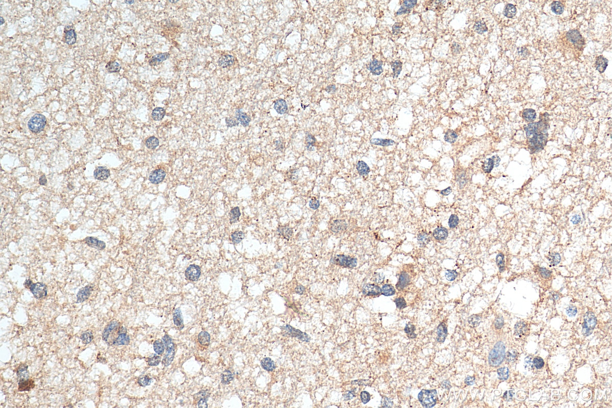 Immunohistochemistry (IHC) staining of human gliomas tissue using CXCL1 Polyclonal antibody (12335-1-AP)