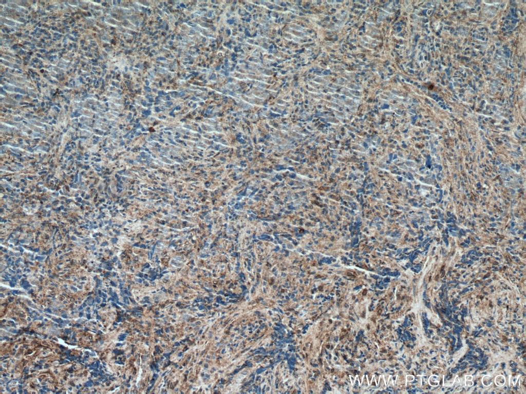 Immunohistochemistry (IHC) staining of human nasopharyngeal carcinoma tissue using CXCL10/IP10 Polyclonal antibody (10937-1-AP)