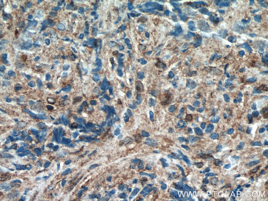 Immunohistochemistry (IHC) staining of human nasopharyngeal carcinoma tissue using CXCL10/IP10 Polyclonal antibody (10937-1-AP)
