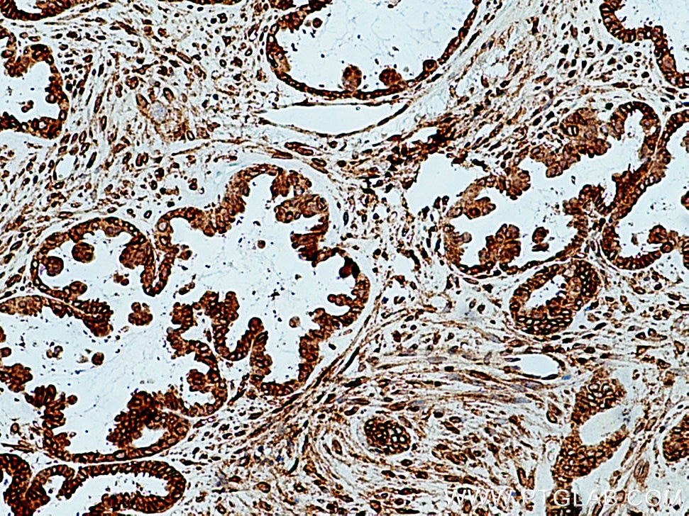 IHC staining of human ovary tumor using 10937-1-AP