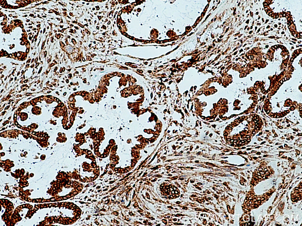 Immunohistochemistry (IHC) staining of human ovary tumor tissue using CXCL10/IP10 Polyclonal antibody (10937-1-AP)