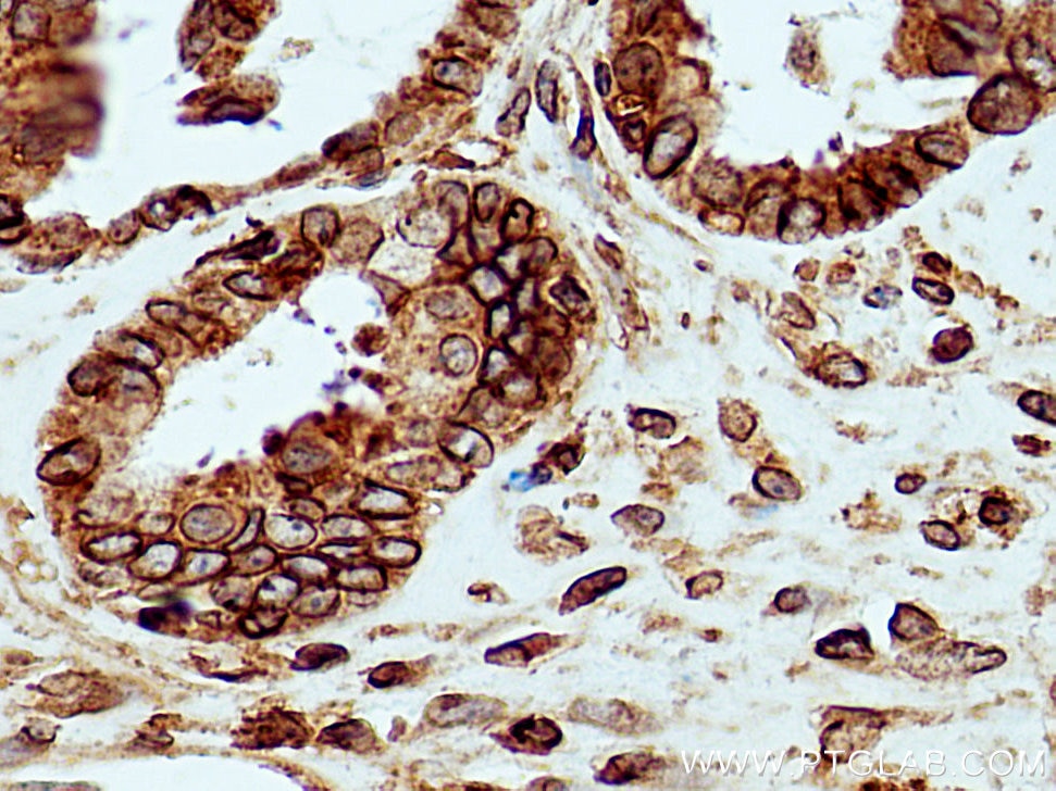 Immunohistochemistry (IHC) staining of human ovary tumor tissue using CXCL10/IP10 Polyclonal antibody (10937-1-AP)