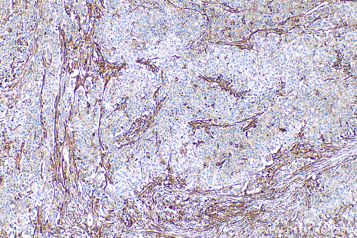 IHC staining of human stomach cancer using 10937-1-AP