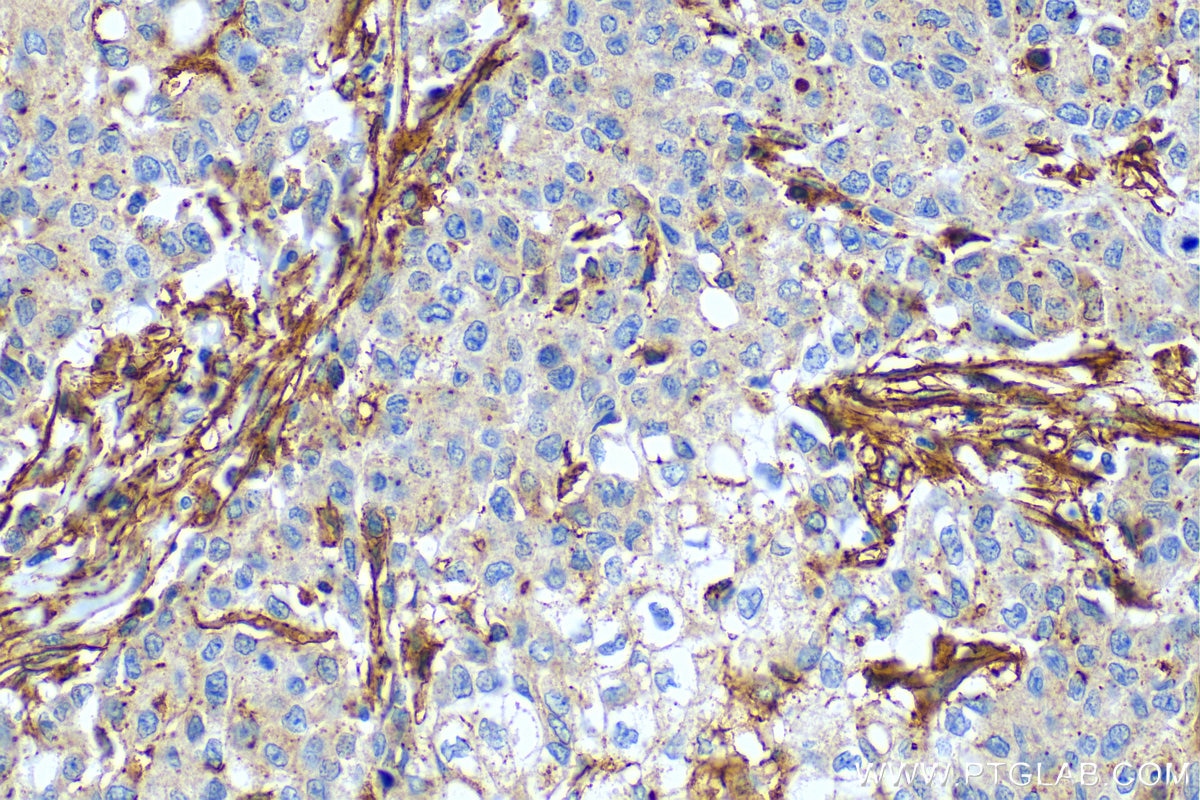 Immunohistochemistry (IHC) staining of human stomach cancer tissue using CXCL10/IP10 Polyclonal antibody (10937-1-AP)