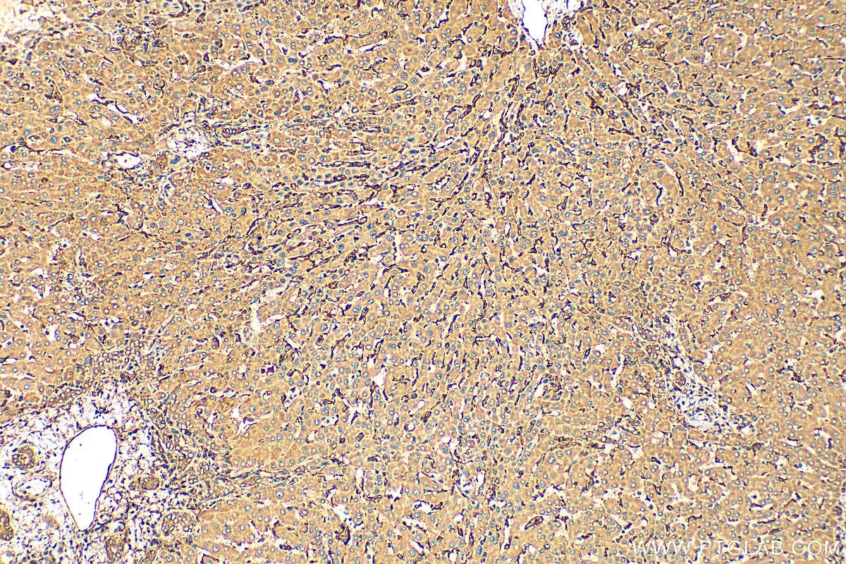 Immunohistochemistry (IHC) staining of human hepatocirrhosis tissue using CXCL10/IP10 Polyclonal antibody (10937-1-AP)