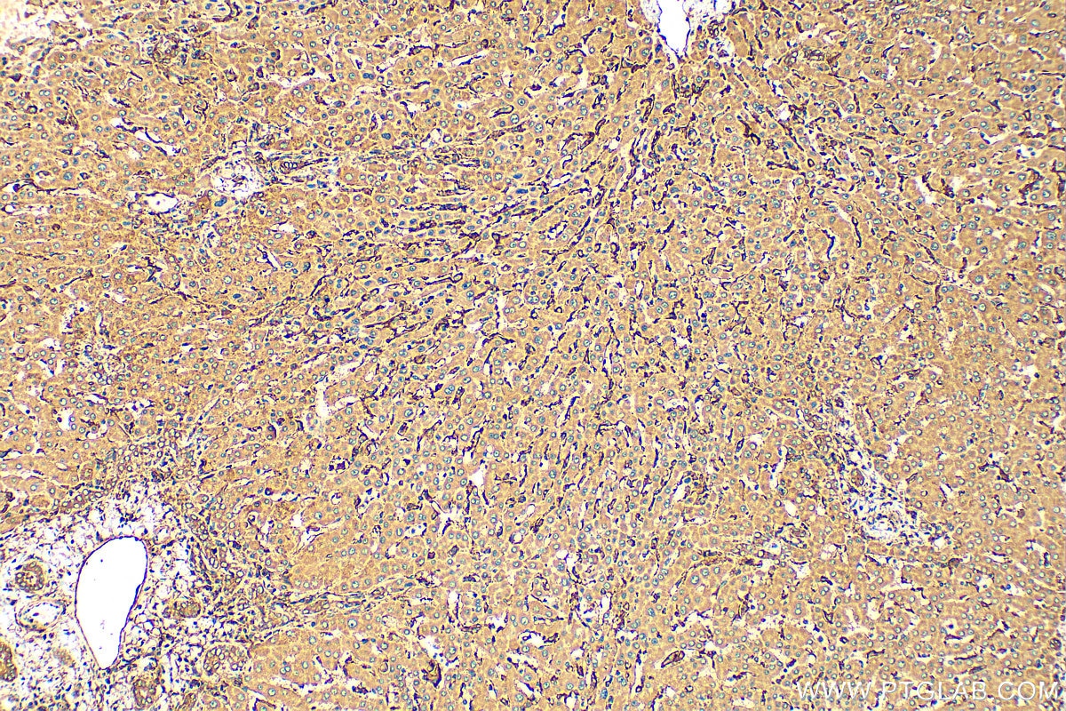 IHC staining of human hepatocirrhosis using 10937-1-AP