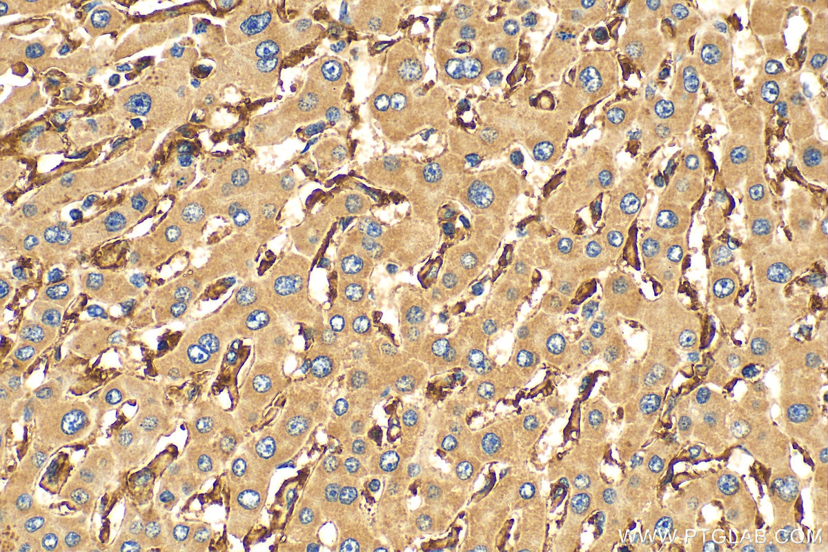 Immunohistochemistry (IHC) staining of human hepatocirrhosis tissue using CXCL10/IP10 Polyclonal antibody (10937-1-AP)