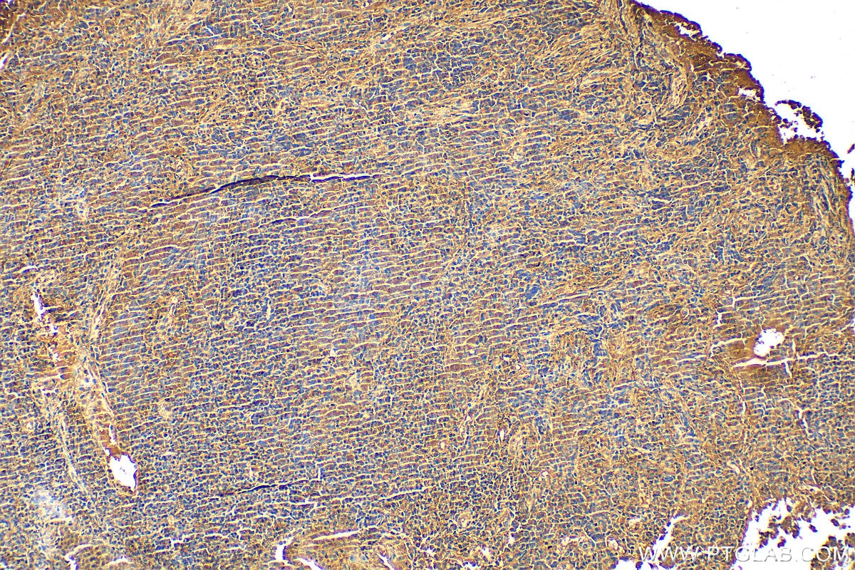 Immunohistochemistry (IHC) staining of human nasopharyngeal carcinoma tissue using CXCL10/IP10 Polyclonal antibody (10937-1-AP)