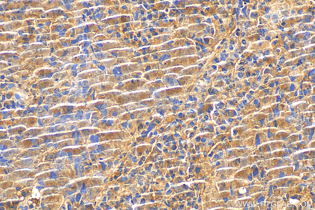 Immunohistochemistry (IHC) staining of human nasopharyngeal carcinoma tissue using CXCL10/IP10 Polyclonal antibody (10937-1-AP)