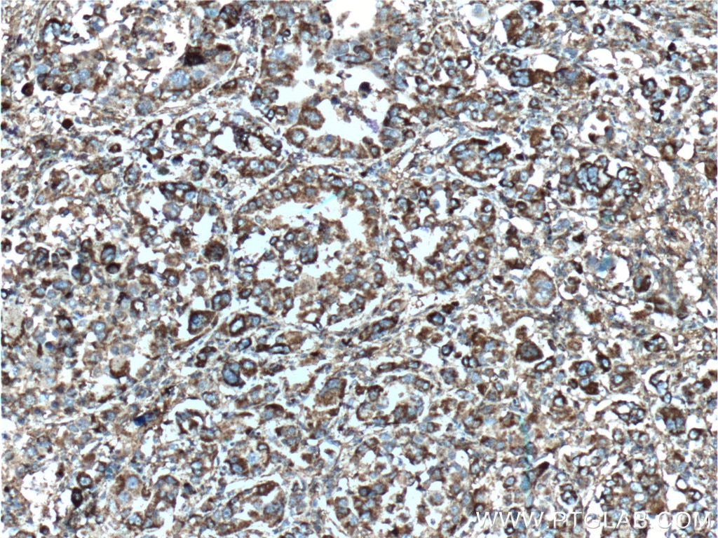 Immunohistochemistry (IHC) staining of human liver cancer tissue using CXCL10/IP10 Polyclonal antibody (10937-1-AP)