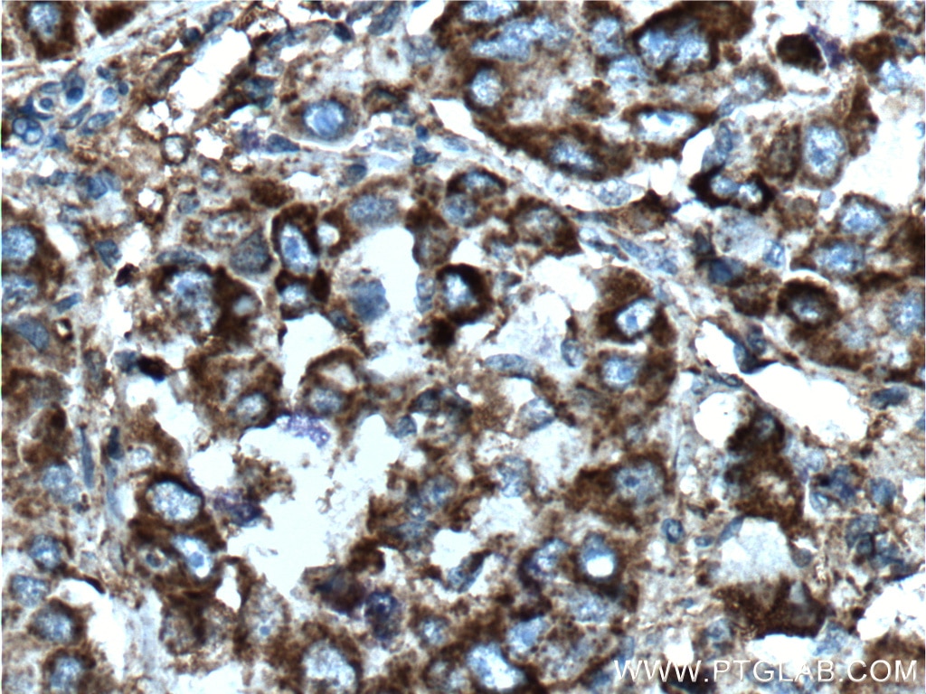 Immunohistochemistry (IHC) staining of human liver cancer tissue using CXCL10/IP10 Polyclonal antibody (10937-1-AP)