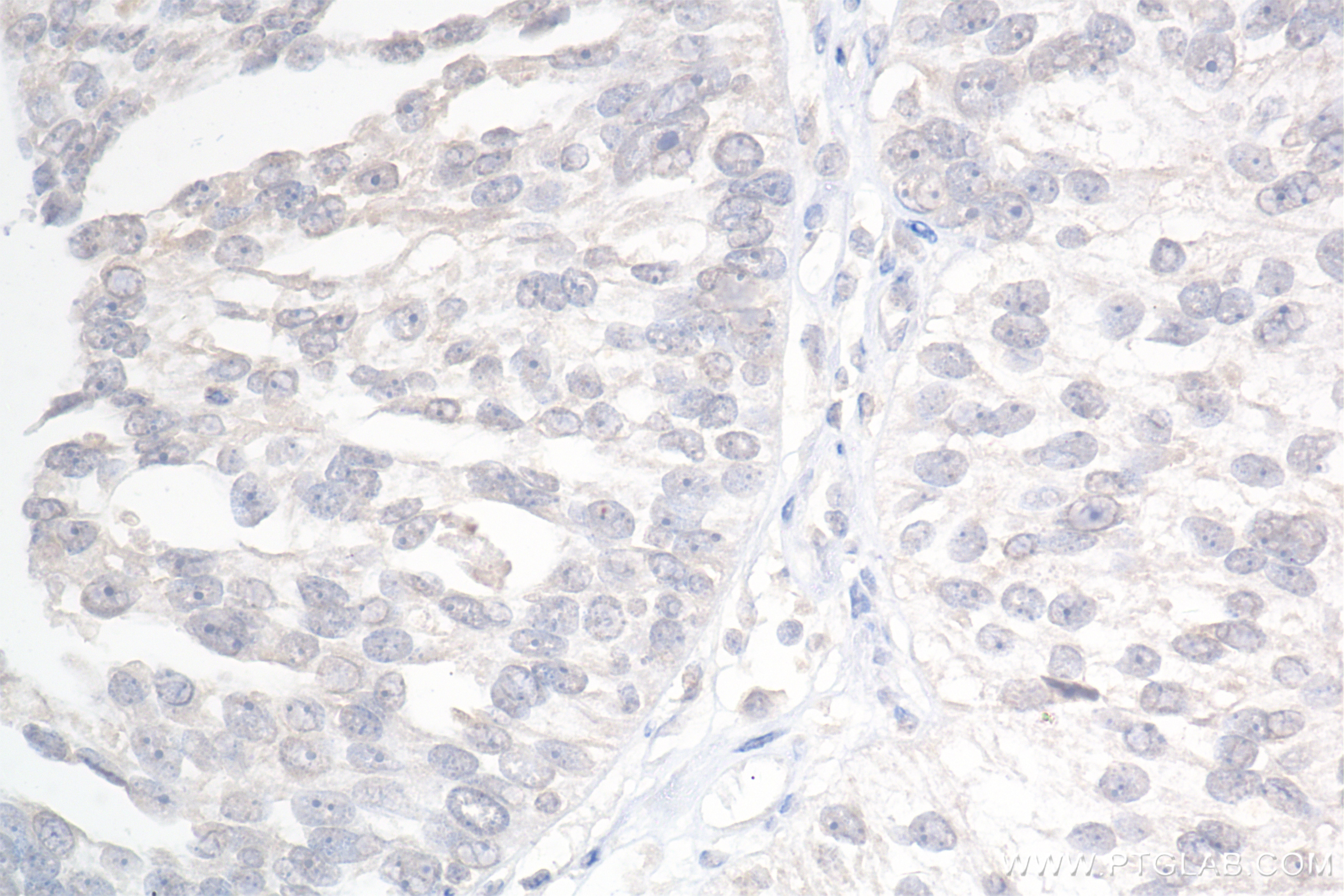 Immunohistochemistry (IHC) staining of human ovary cancer tissue using CXCL10/IP-10 Recombinant antibody (85307-1-RR)