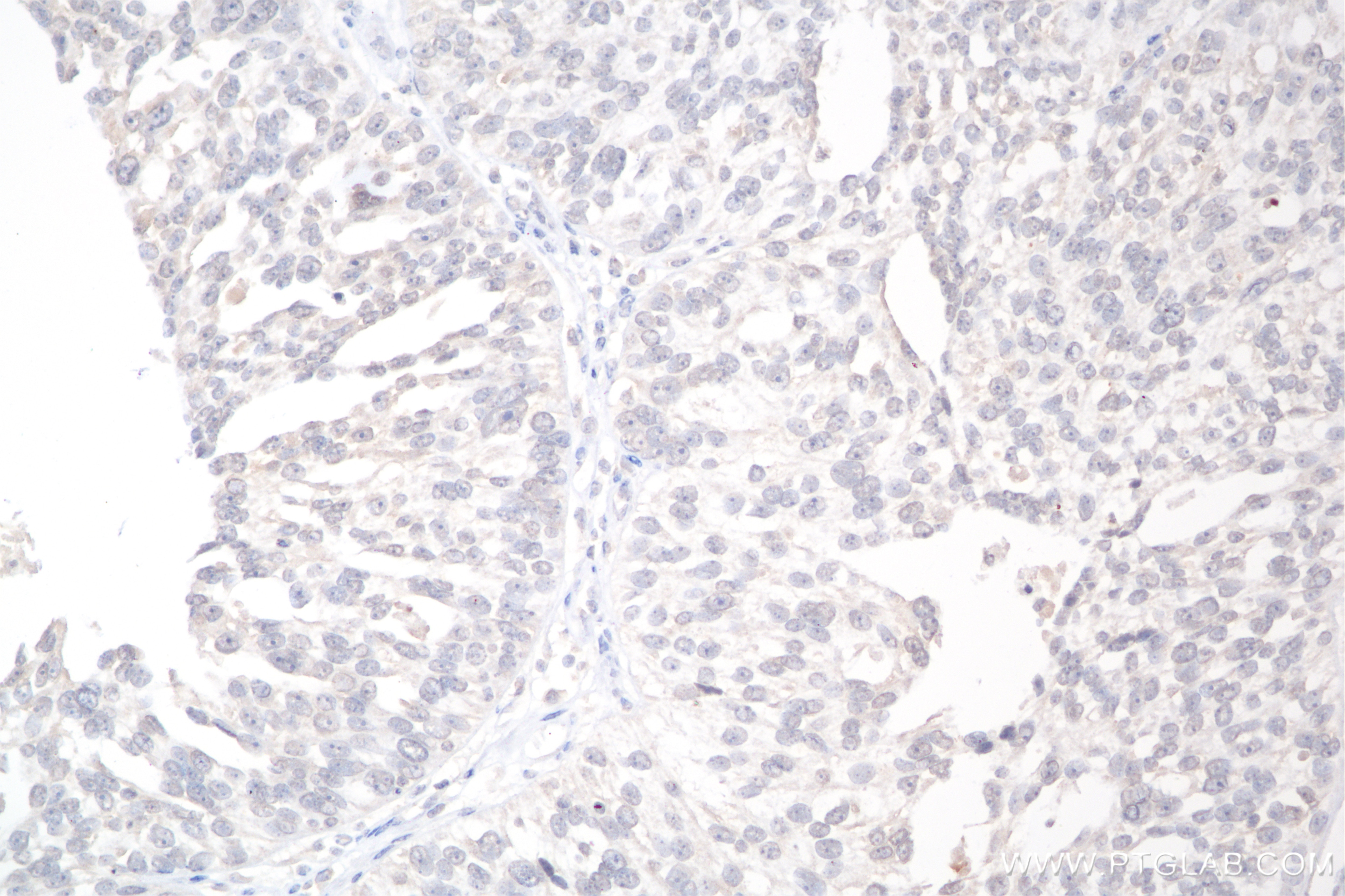 Immunohistochemistry (IHC) staining of human ovary cancer tissue using CXCL10/IP-10 Recombinant antibody (85307-1-RR)