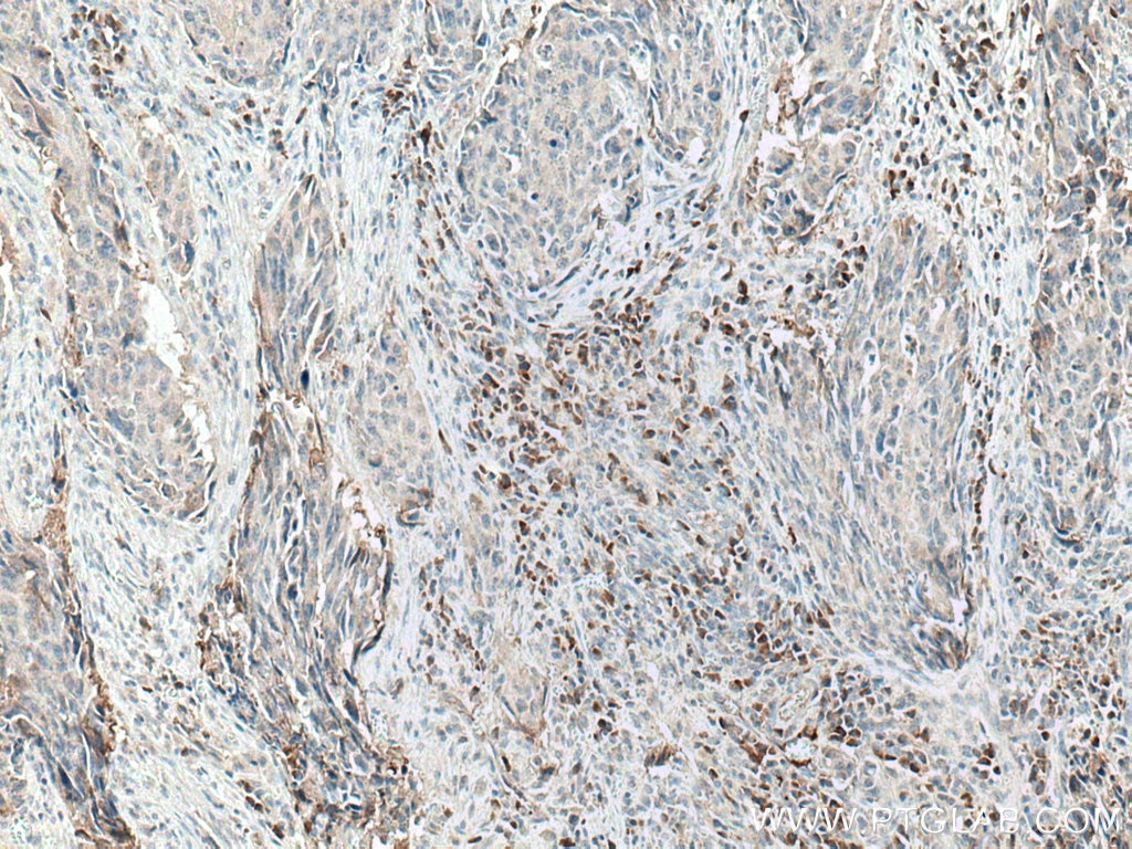 Immunohistochemistry (IHC) staining of human colon cancer tissue using CXCL11 Polyclonal antibody (10707-1-AP)