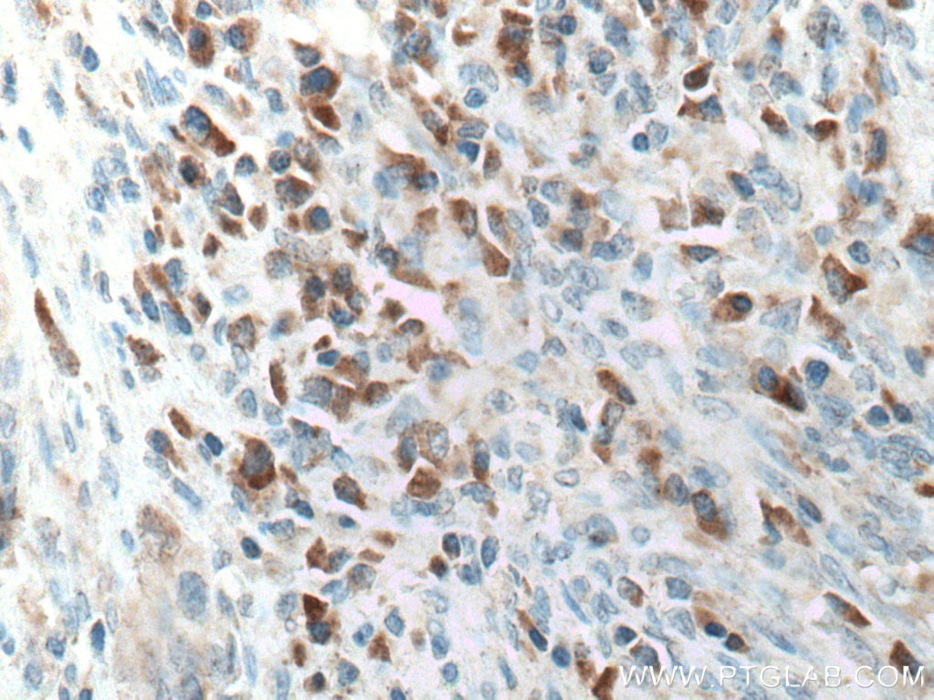 Immunohistochemistry (IHC) staining of human colon cancer tissue using CXCL11 Polyclonal antibody (10707-1-AP)
