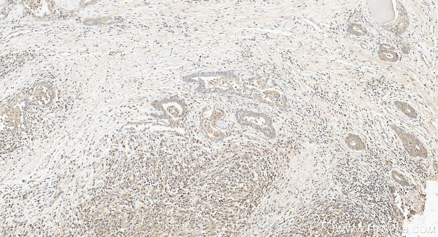 IHC staining of human prostate cancer using 10707-1-AP Immunohistochemistry (IHC) staining of human prostate cancer tissue using CXCL11 Polyclonal antibody (10707-1-AP)