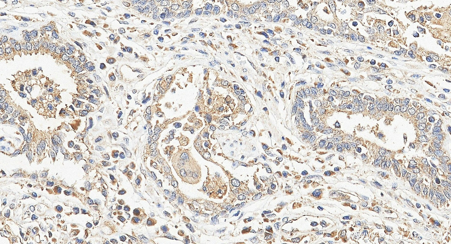 IHC staining of human prostate cancer using 10707-1-AP Immunohistochemistry (IHC) staining of human prostate cancer tissue using CXCL11 Polyclonal antibody (10707-1-AP)