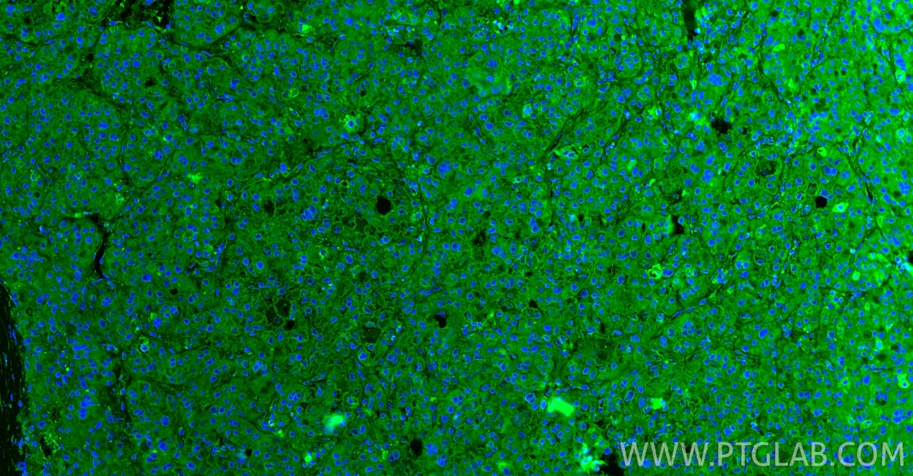 Immunofluorescence (IF) / fluorescent staining of human liver cancer tissue using CXCL12/SDF-1 Polyclonal antibody (17402-1-AP)
