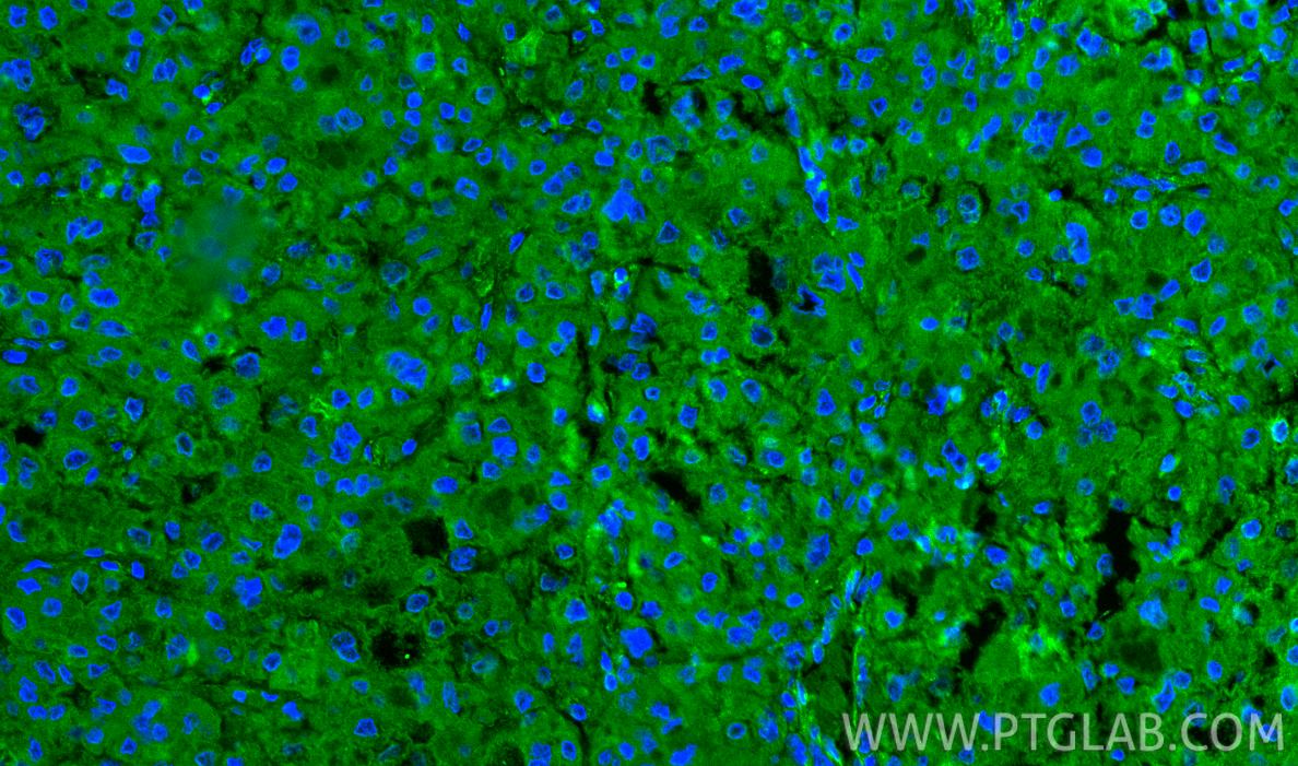Immunofluorescence (IF) / fluorescent staining of human liver cancer tissue using CXCL12/SDF-1 Polyclonal antibody (17402-1-AP)