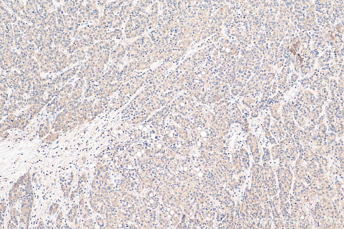 Immunohistochemistry (IHC) staining of human liver cancer tissue using CXCL12/SDF-1 Polyclonal antibody (17402-1-AP)