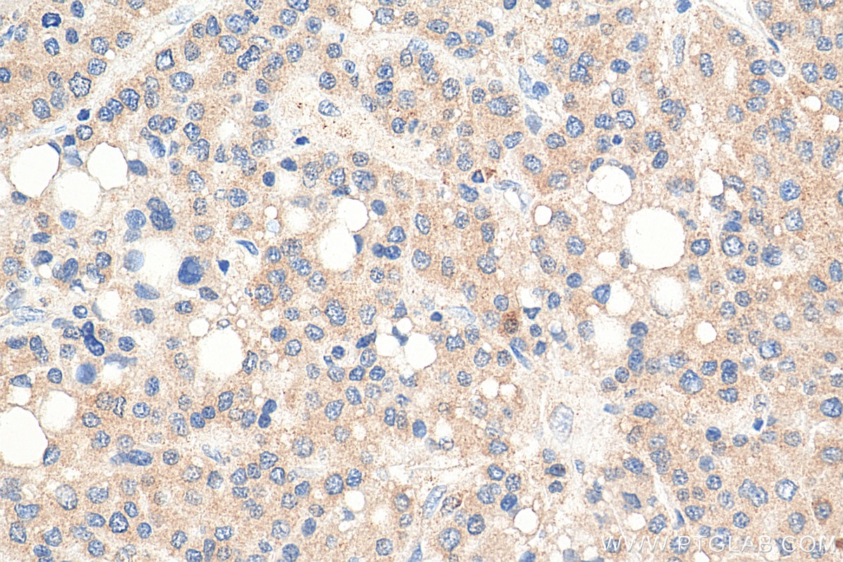 Immunohistochemistry (IHC) staining of human liver cancer tissue using CXCL12/SDF-1 Polyclonal antibody (17402-1-AP)