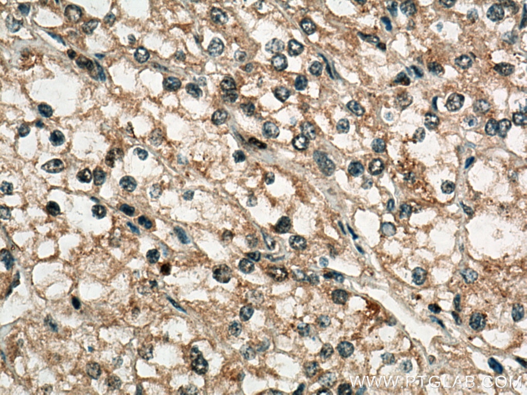 Immunohistochemistry (IHC) staining of human renal cell carcinoma tissue using CXCL13/BCA1 Polyclonal antibody (10927-1-AP)