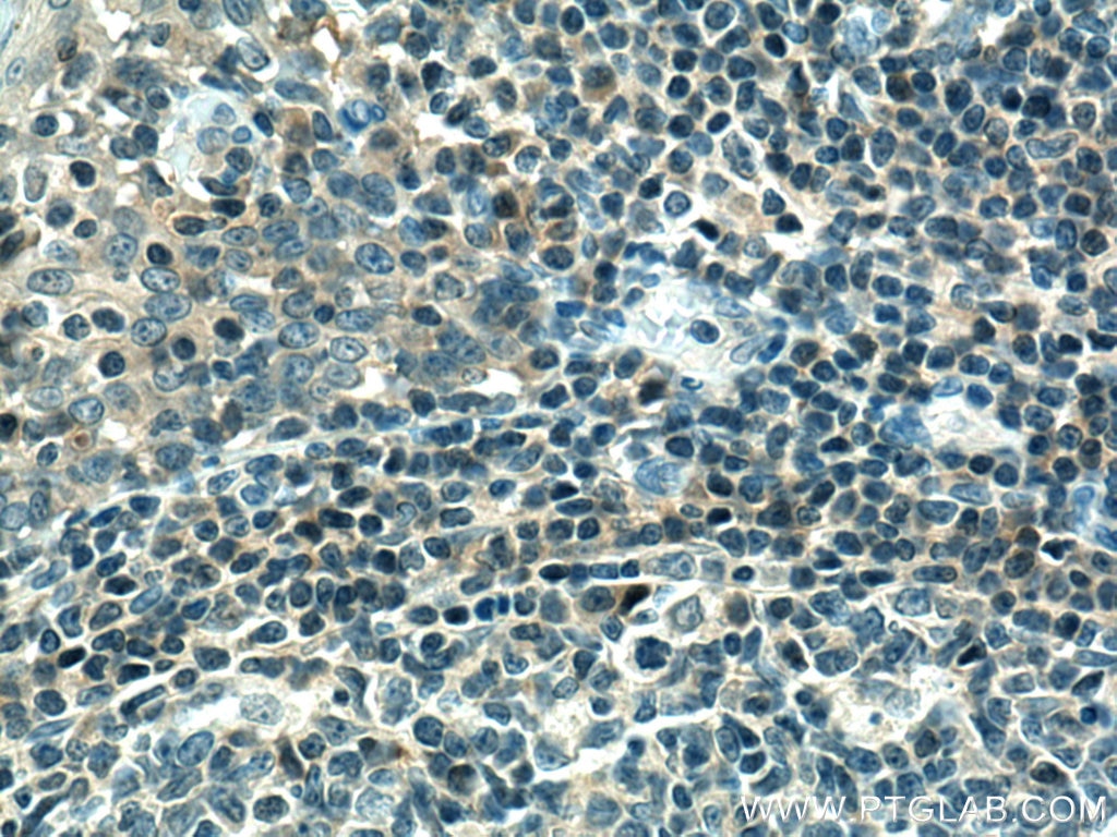 Immunohistochemistry (IHC) staining of human tonsillitis tissue using CXCL13/BCA1 Polyclonal antibody (10927-1-AP)