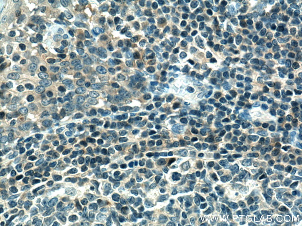 IHC staining of human tonsillitis using 10927-1-AP