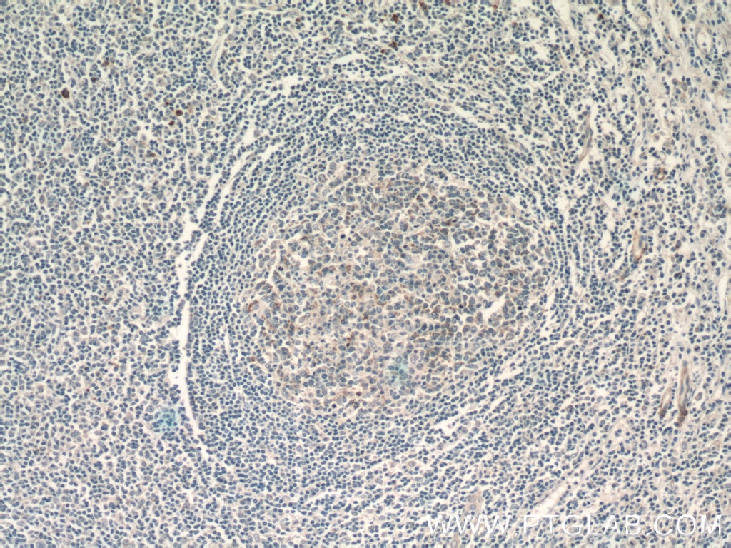 IHC staining of human tonsillitis using 10927-1-AP