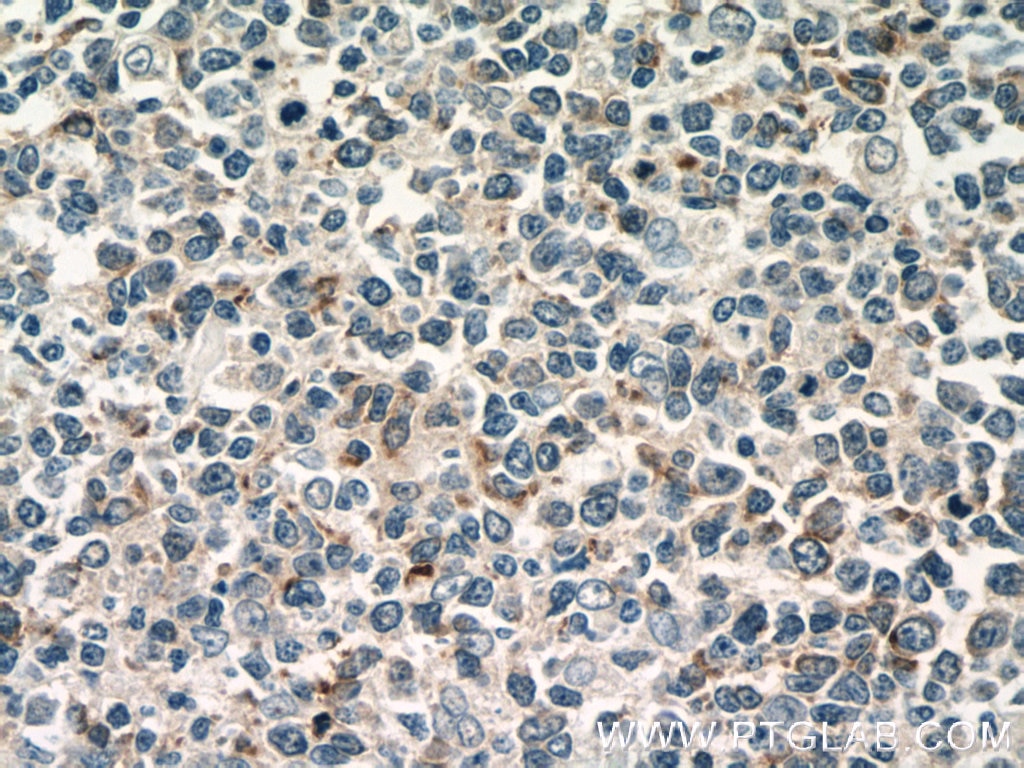 IHC staining of human tonsillitis using 10927-1-AP